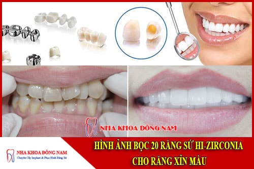 Hình ảnh bọc răng sứ tại nha khoa đông nam