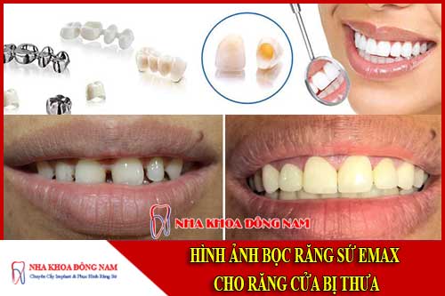 Hình ảnh bọc răng sứ cho răng bị thưa