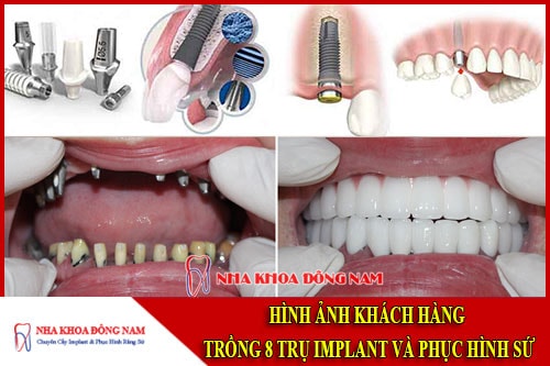 Hình ảnh cấy ghép 8 trụ implant và phục hình răng sứ