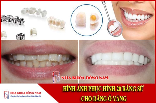 Hình ảnh phục hình sứ cho răng bị ố vàng