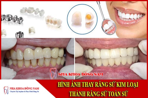 Hình ảnh thay răng sứ kim loại bằng răng toàn sứ