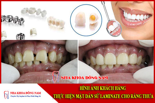 mặt dán sứ laminate cho răng thưa
