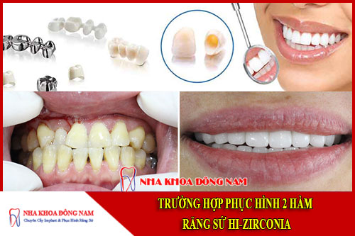 trường hợp phục hình 2 hàm răng sứ hi-zirconia
