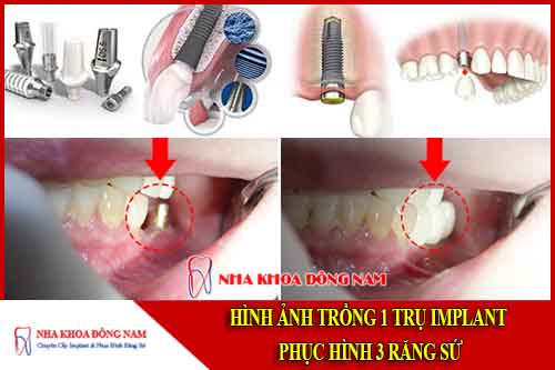 hình ảnh trồng 1 trụ implant phục hình 3 răng sứ