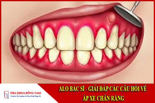 alo bác sĩ - giải đáp câu hỏi về áp xe chân răng