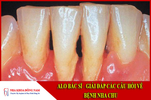 alo bác sĩ - giải đáp câu hỏi về bệnh nha chu