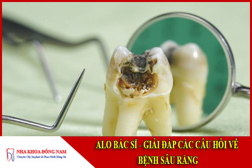 Alo bác sĩ - giải đáp các câu hỏi về bệnh sâu răng