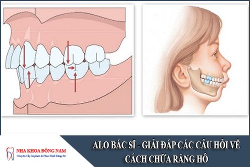giải đáp các câu hỏi về cách chữa răng hô