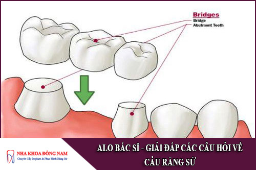 giải đáp các câu hỏi về cầu răng sứ