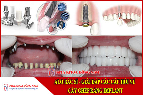 Alo bác sĩ - giải đáp các câu hỏi về cấy ghép implant