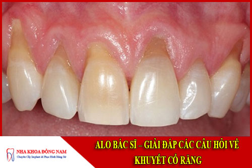 Alo bác sĩ - Giải đáp các câu hỏi về khuyết cổ răng