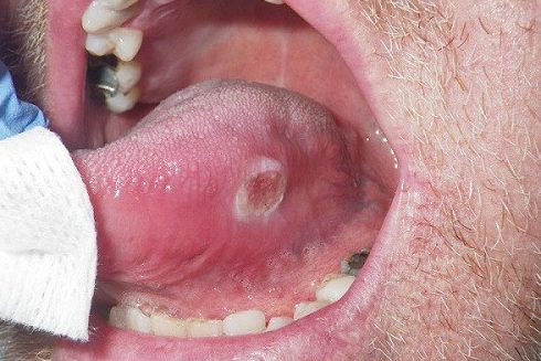 Alo bác sĩ - Giải đap các câu hỏi về bệnh nhiệt miệng lỡ miệng 2