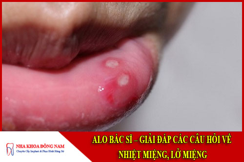 Alo bác sĩ - Giải đap các câu hỏi về bệnh nhiệt miệng lỡ miệng