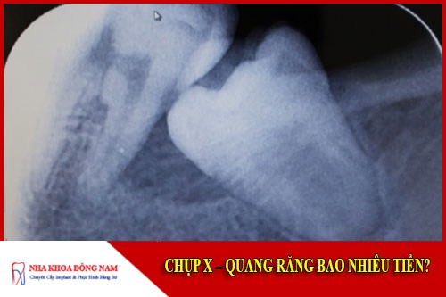 Chụp X-Quang răng bao nhiêu tiền