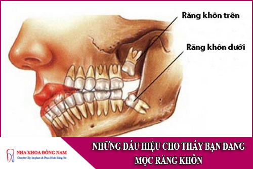 những dấu hiệu cho thấy bạn đang mọc răng khôn