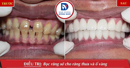 điều trị răng nhiễm tetracycline