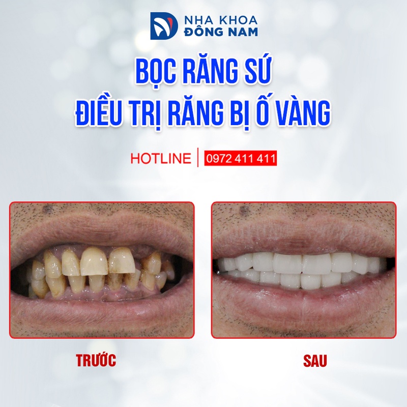 Hình ảnh bọc răng sứ Zirconia cho răng ố vàng