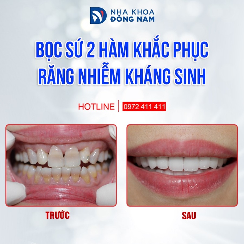 Hình ảnh thực tế bọc răng sứ Zirconia cho răng nhiễm Tetracycline nặng