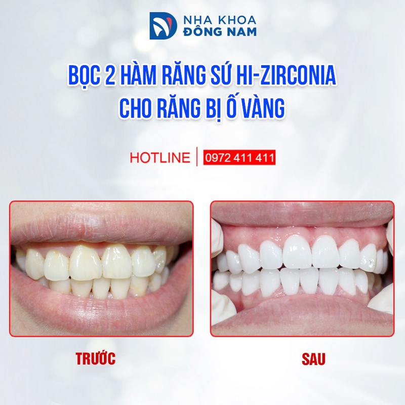 Hình ảnh thực tế về ca bọc răng toàn sứ cao cấp Hi – Zirconia tại Nha Khoa Đông Nam