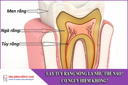 lấy tủy răng sống như thế nào? có nguy hiểm không