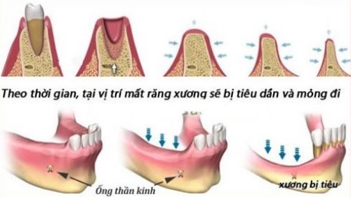 Quá trình tiêu xương hàm sau khi mất răng có nhanh không