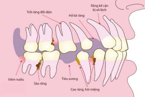 Quá trình tiêu xương hàm sau khi mất răng có nhanh không 3