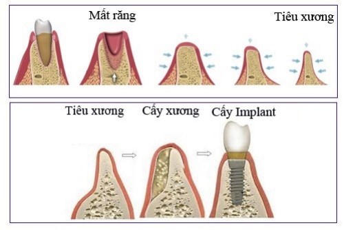 Quá trình tiêu xương hàm sau khi mất răng có nhanh không 7