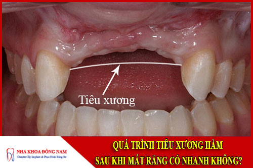 Quá trình tiêu xương hàm sau khi mất răng có nhanh không