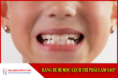Răng bé mọc lệch thì phải làm sao