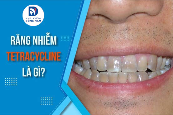 răng nhiễm tetracycline có tẩy trắng được không