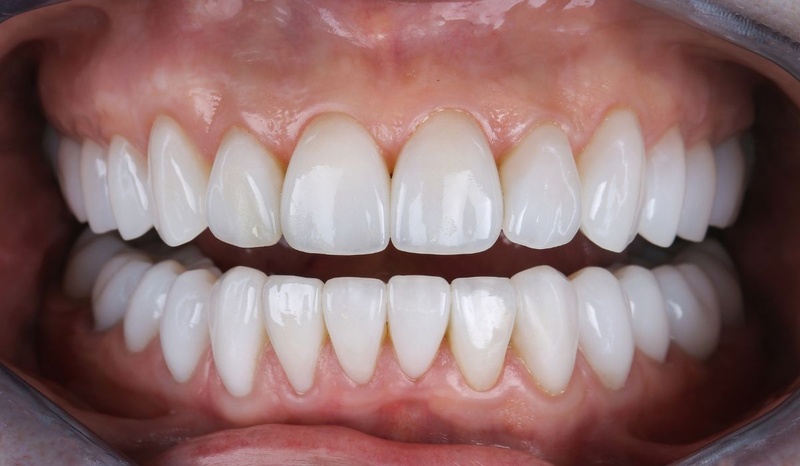 Răng sứ Cercon cho màu sắc hài hòa tự nhiên như răng thật