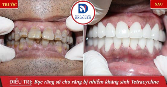 răng sứ cercon và zirconia