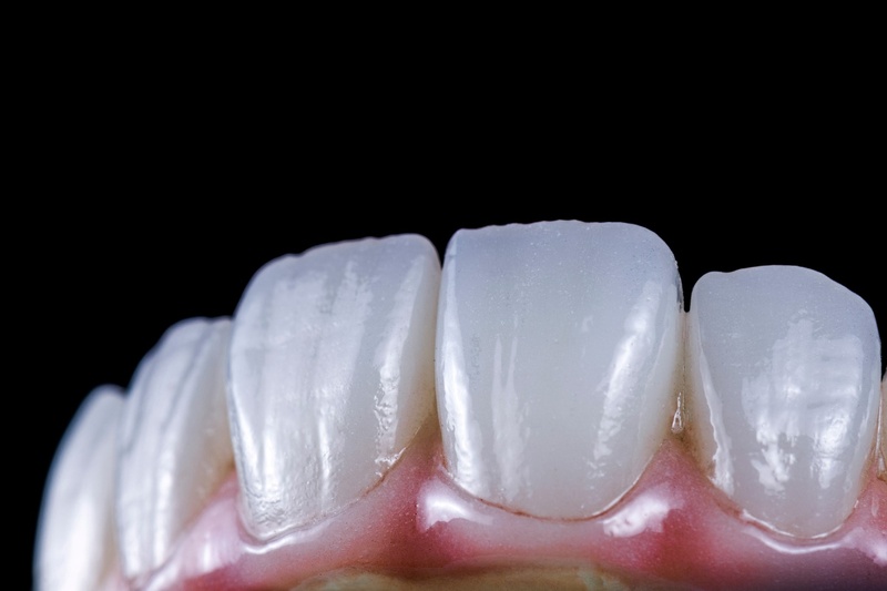 Răng sứ Zirconia có tuổi thọ cao hơn so với răng sứ Cercon
