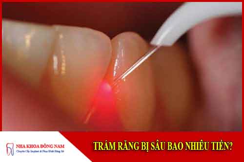 Trám răng bị sâu bao nhiêu tiền