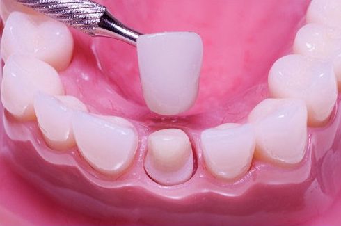 Alo bác sĩ - Giải đáp các câu hỏi về lấy tủy răng 3