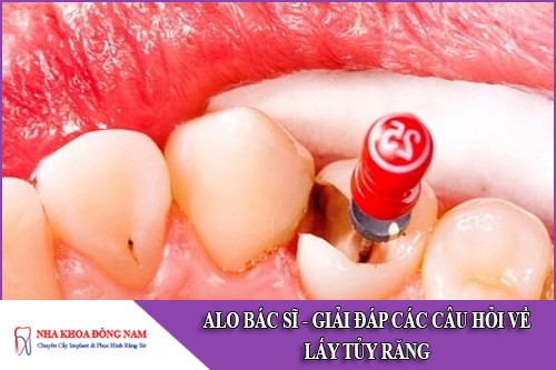 giải đáp các câu hỏi về lấy tủy răng
