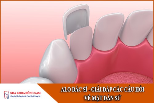 giải đáp các câu hỏi về mặt dán sứ