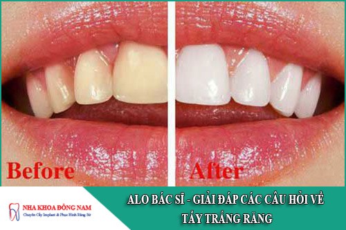 giải đáp các câu hỏi về tẩy trắng răng