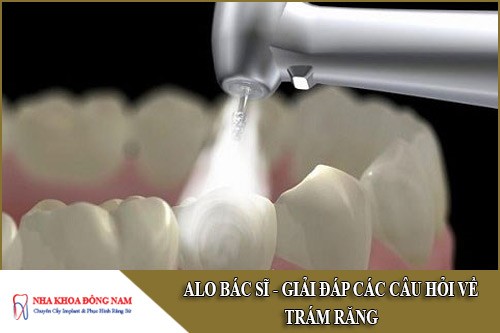 giải đáp các câu hỏi về trám răng