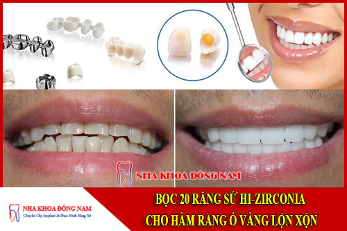 Bọc răng sứ hi-zirconia cho hàm răng ố vàng và lộn xộn