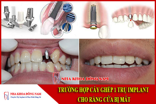 trường hợp cấy ghép 1 trụ implant cho răng cửa bên bị mất