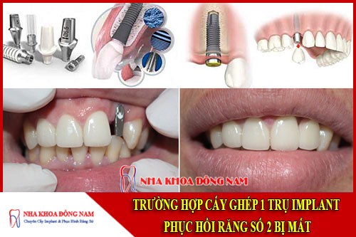 Cấy ghép 1 trụ implant phục hồi răng số 2 bị mất