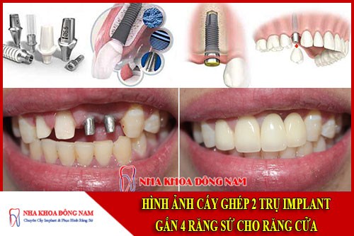 Cấy ghép 2 trụ implant gắn 4 răng sứ