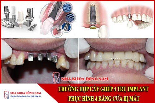 Cấy ghép 4 trụ Implant và phục hình 4 răng sứ