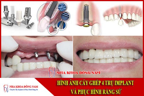 Cấy ghép implant và phục hình răng sứ