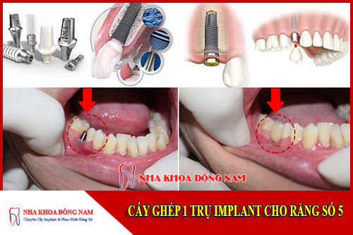 Cấy ghép implant cho răng số 5