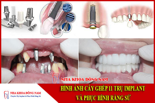 Cấy ghép implant và phục hình răng sứ