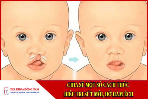 Chia sẻ một số cách điều trị sứt môi