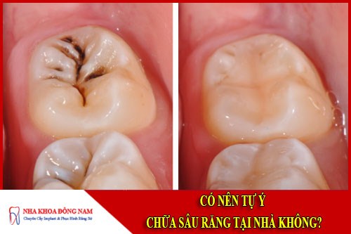 có nên tự ý chữa sâu răng tại nhà không