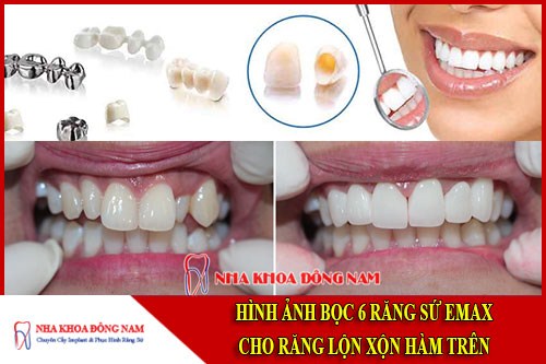 Hình ảnh bọc răng sứ cho răng mọc lộn xộn